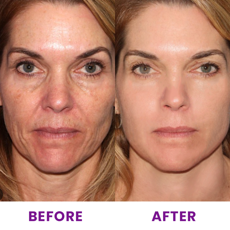 LIMETOW™ Pro-Xylane Rejuvenating Face Serum