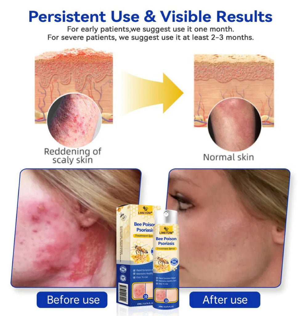 LIMETOW® Bee Venom Psoriasis Treatment Spray
