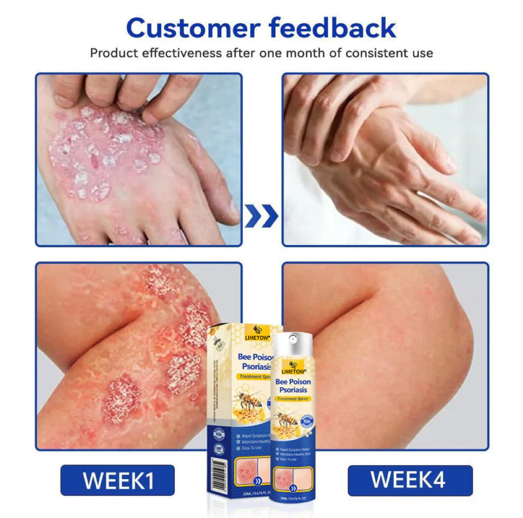 LIMETOW® Bee Venom Psoriasis Treatment Spray
