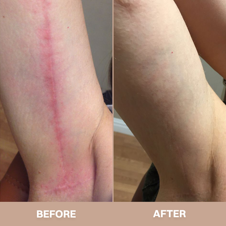 LIMETOW® Silicone Scar Stick
