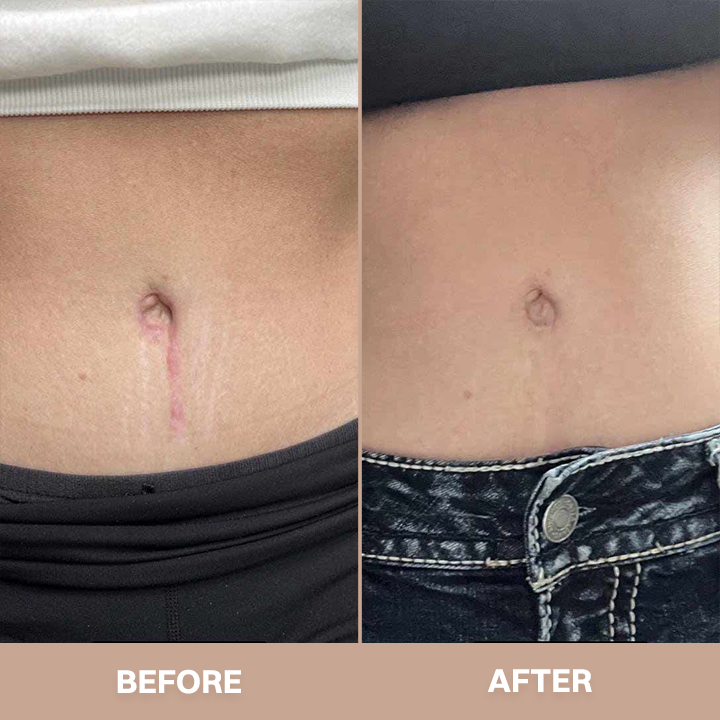 LIMETOW® Silicone Scar Stick