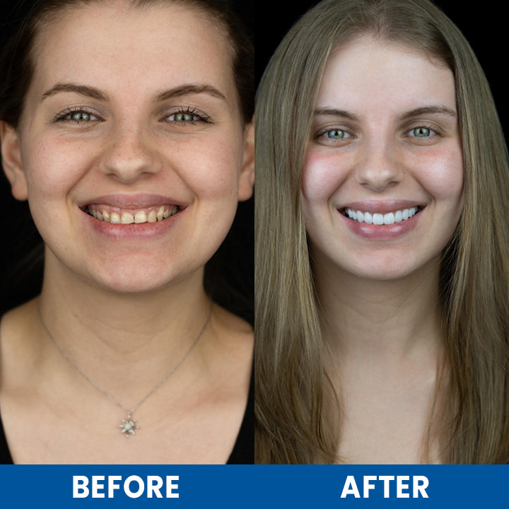 LIMETOW™ Teeth Whitening Essence