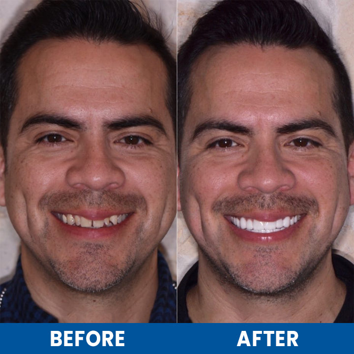 LIMETOW™ Teeth Whitening Essence