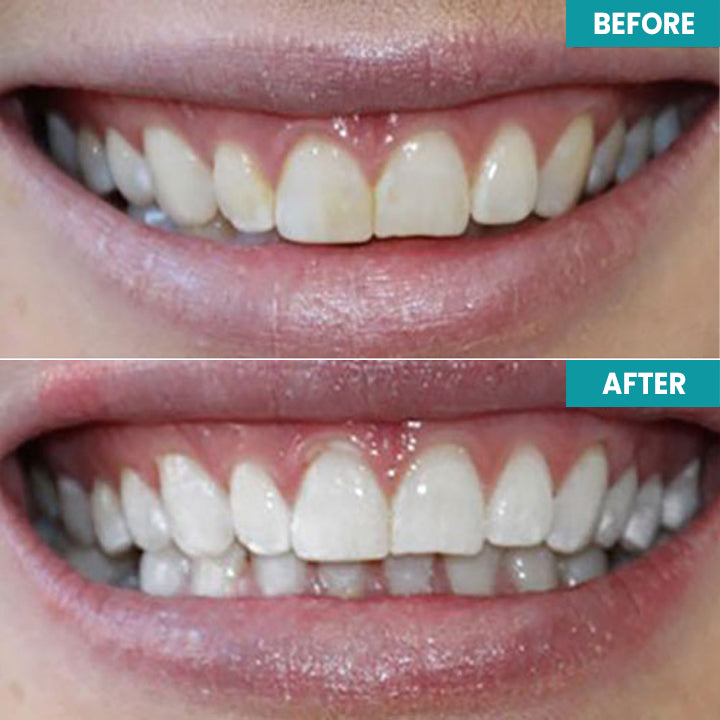 LIMETOW™ Instant Teeth Whitening Paint