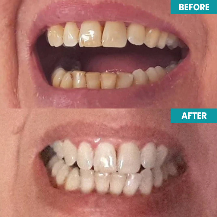 LIMETOW™ Instant Teeth Whitening Paint