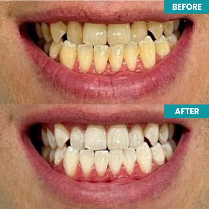 LIMETOW™ Instant Teeth Whitening Paint