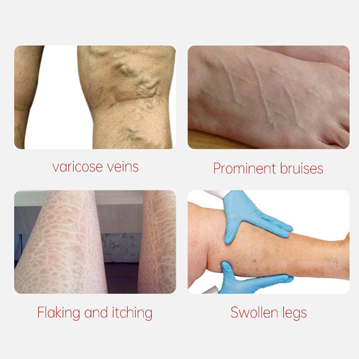 LIMETOW™Varicose Veins Relief Cream