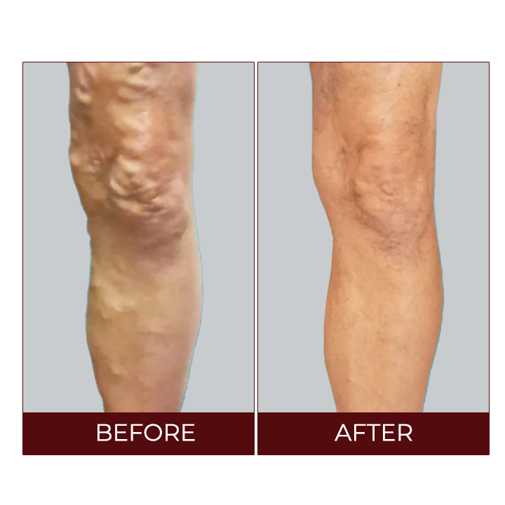 LIMETOW™Varicose Veins Relief Cream