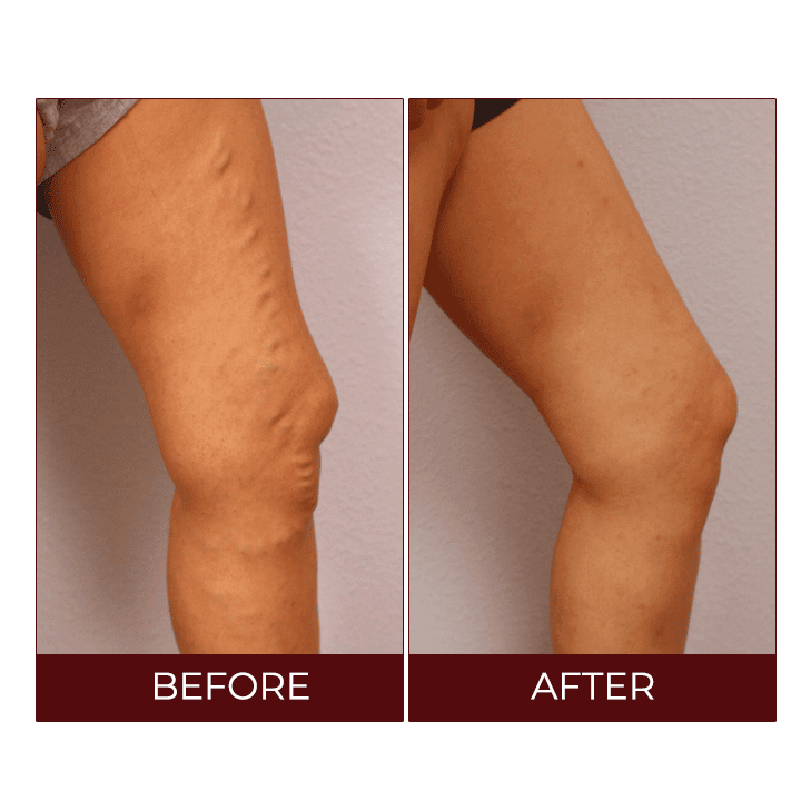 LIMETOW™Varicose Veins Relief Cream