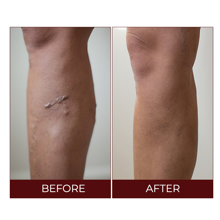 LIMETOW™Varicose Veins Relief Cream