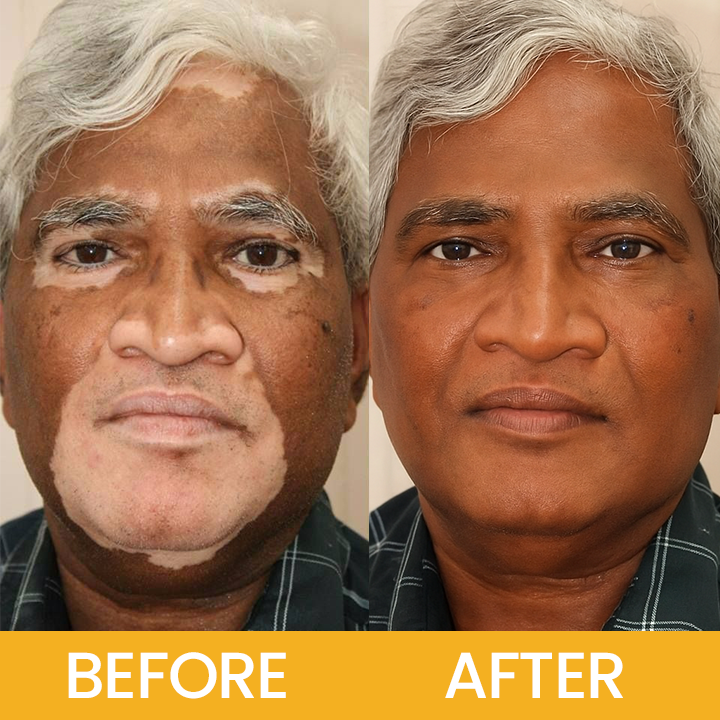 LIMETOW® Vitiligo Bee Venom Cream