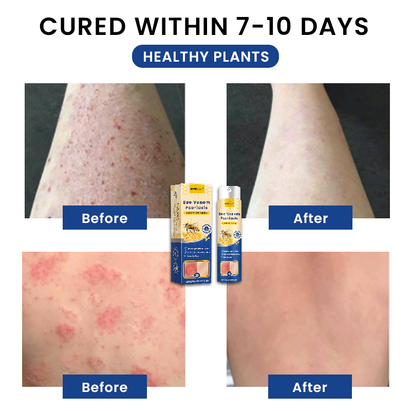 Official Store： LIMETOW® Bee Venom Psoriasis Treatment Spray