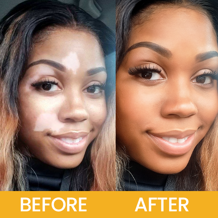LIMETOW® Vitiligo Bee Venom Cream