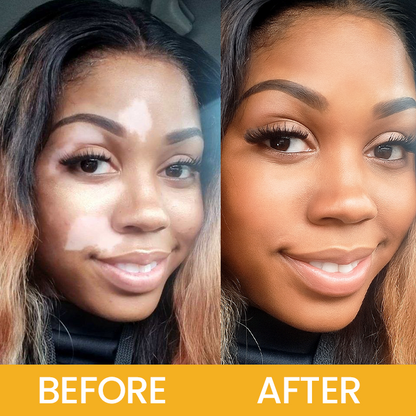 LIMETOW® Vitiligo Bee Venom Cream