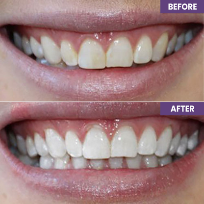 LIMETOW™ Instant Purple Teeth Whitening Paint