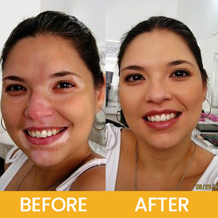 LIMETOW® Vitiligo Bee Venom Cream