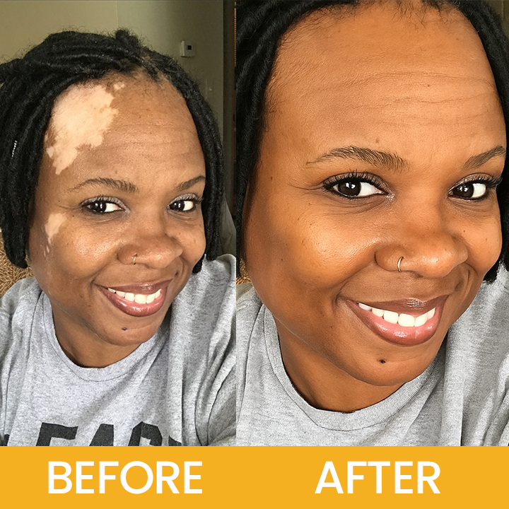 LIMETOW® Vitiligo Bee Venom Cream