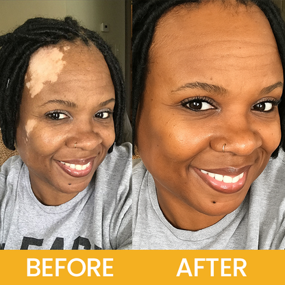 LIMETOW® Vitiligo Bee Venom Cream