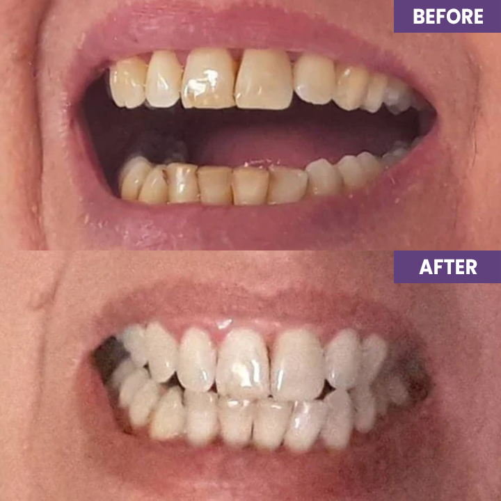 LIMETOW™ Instant Purple Teeth Whitening Paint
