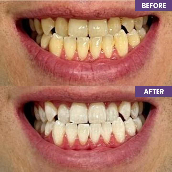 LIMETOW™ Instant Purple Teeth Whitening Paint