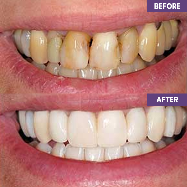 LIMETOW™ Instant Purple Teeth Whitening Paint
