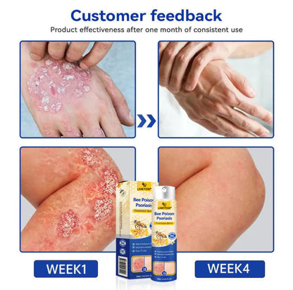 LIMETOW® Bee Venom Psoriasis Treatment Spray