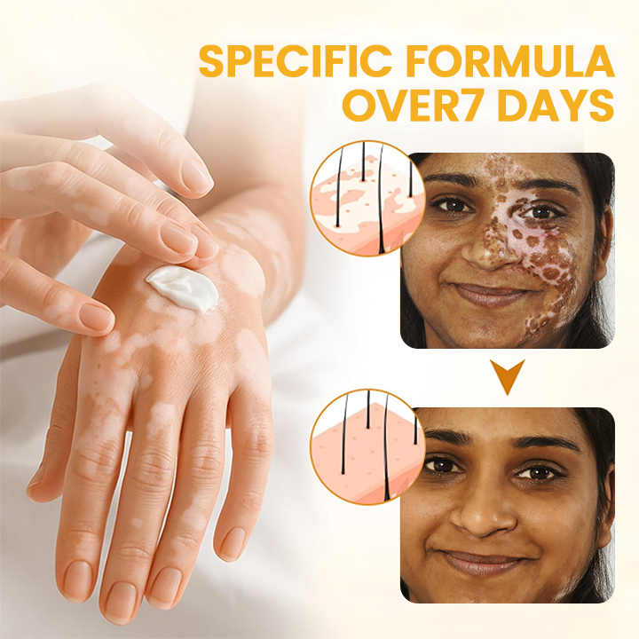 LIMETOW® Vitiligo Bee Venom Cream