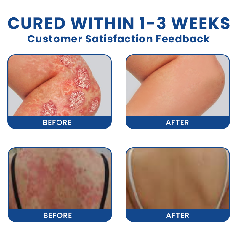 Official Store： LIMETOW® Bee Venom Psoriasis Treatment Spray