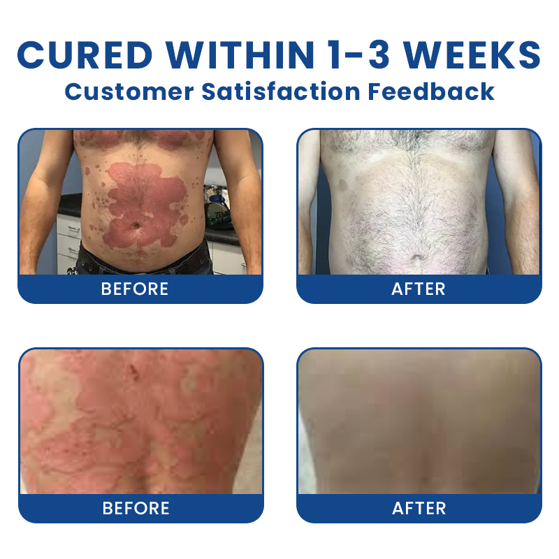 Official Store： LIMETOW® Bee Venom Psoriasis Treatment Spray