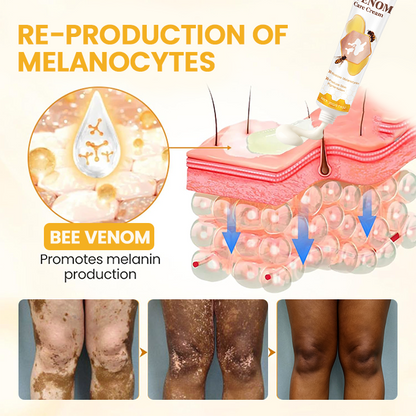 LIMETOW® Vitiligo Bee Venom Cream