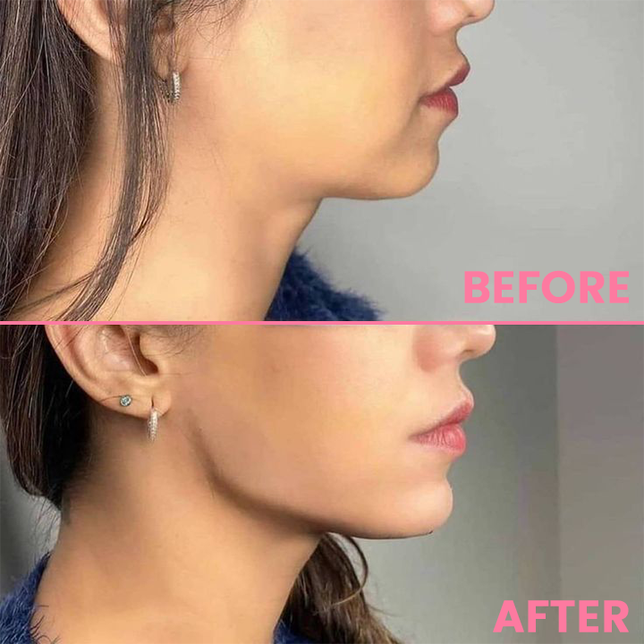 LIMETOW™ Face Lifting Suction Trainer