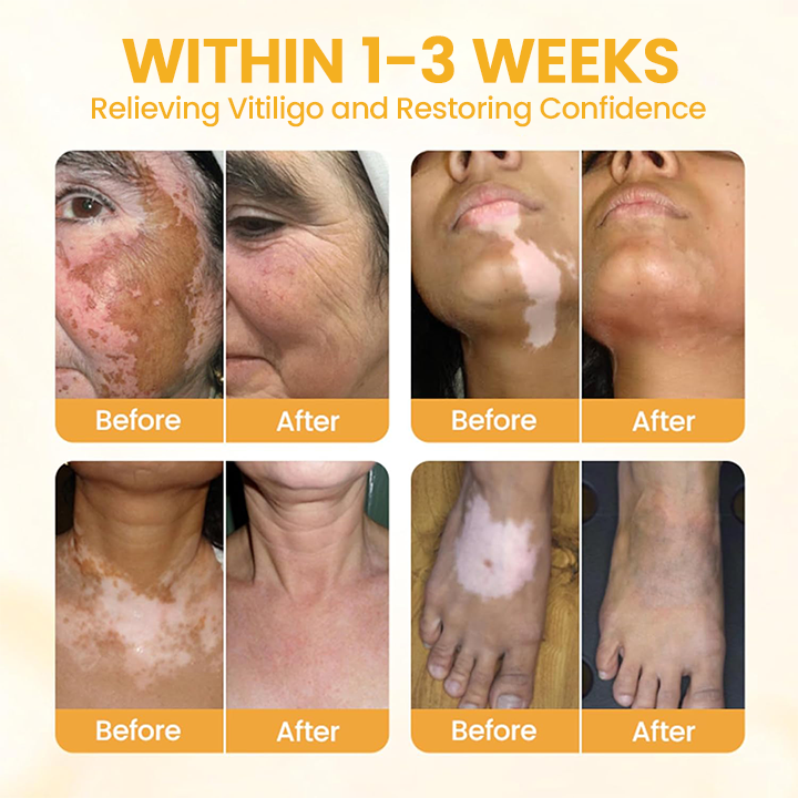 LIMETOW® Vitiligo Bee Venom Cream