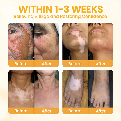 LIMETOW® Vitiligo Bee Venom Cream