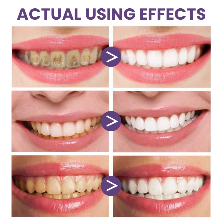 LIMETOW™ Instant Purple Teeth Whitening Paint