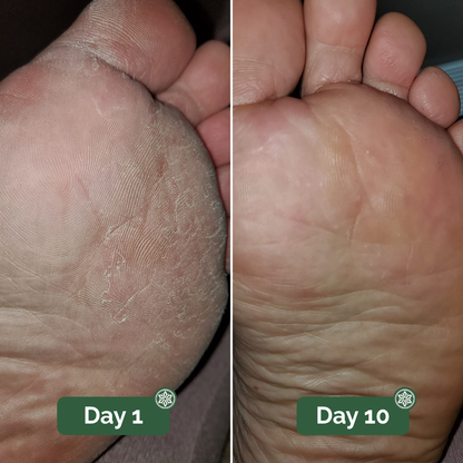 LIMETOW®Antifungal Soap