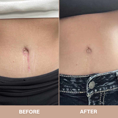 LIMETOW® Silicone Scar Stick
