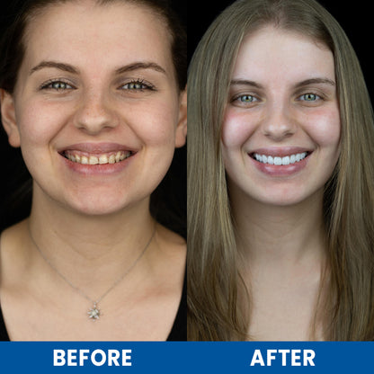 LIMETOW™ Teeth Whitening Essence