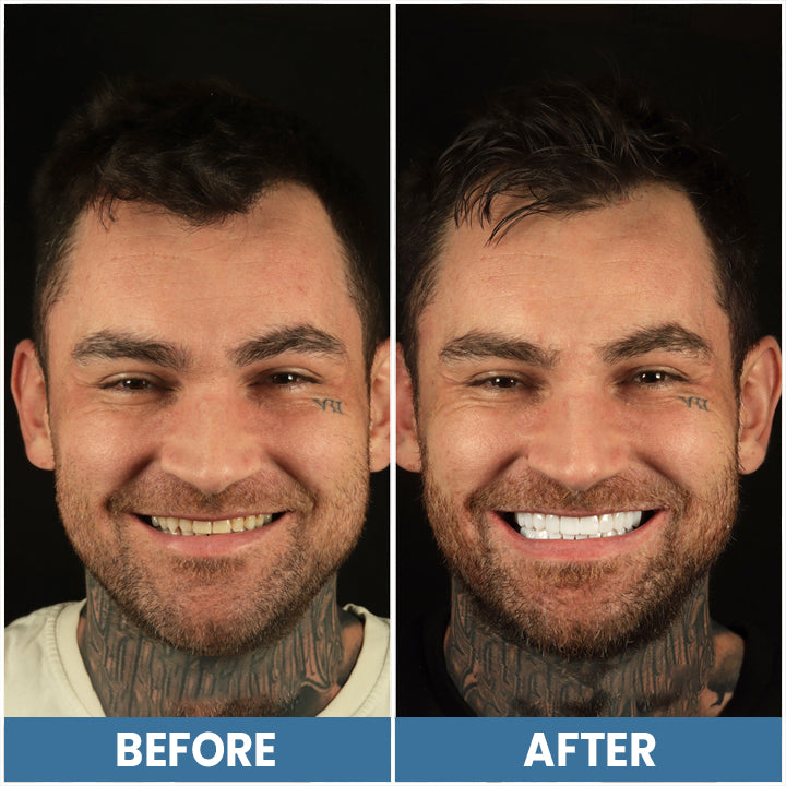 LIMETOW™ Teeth Whitening Pen