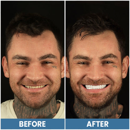 LIMETOW™ Teeth Whitening Pen