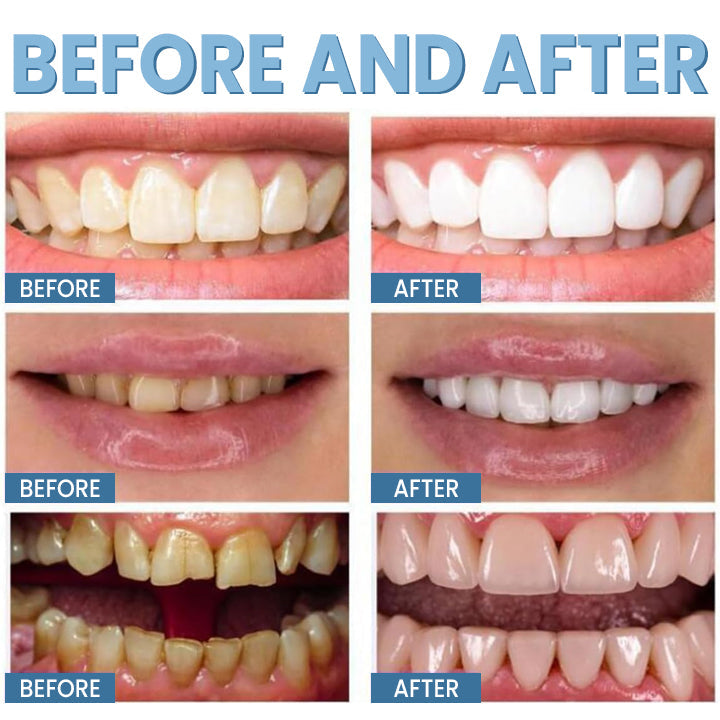 LIMETOW™ Teeth Whitening Pen