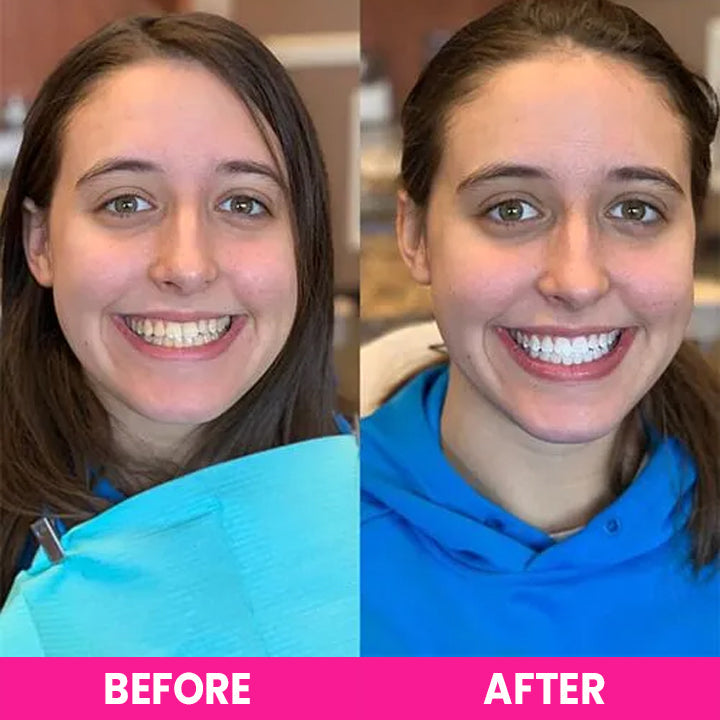 LIMETOW™ Teeth Whitening Strips