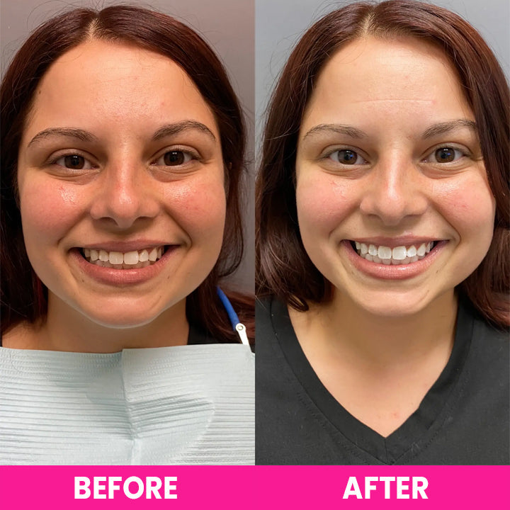 LIMETOW™ Teeth Whitening Strips