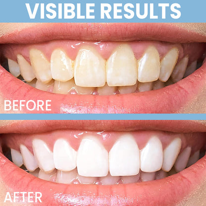 LIMETOW™ Teeth Whitening Pen