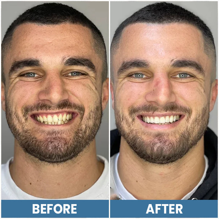 LIMETOW™ Teeth Whitening Pen