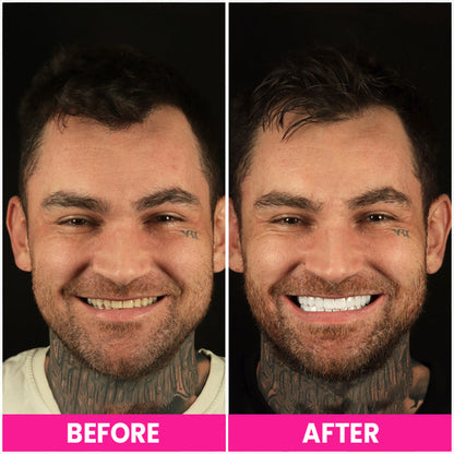 LIMETOW™ Teeth Whitening Pen