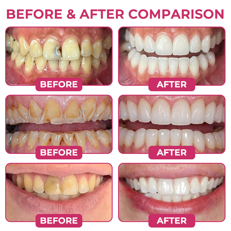 LIMETOW® Cavity-Repair Natural Enamel Filling Gel