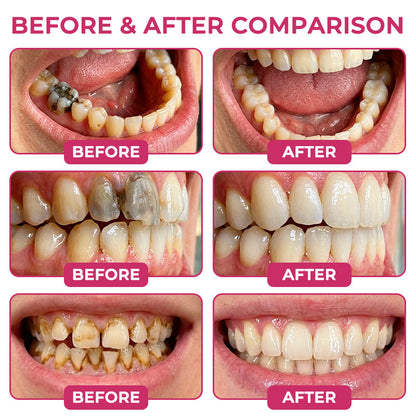 LIMETOW® Cavity-Repair Natural Enamel Filling Gel