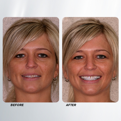 LIMETOW™ Teeth Whitening Spray